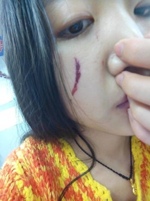 我的脸上前几天被人抓伤了，怎样才能不留下疤痕啊？拜托了各位.脸上被抓伤如何避免留疤？紧急求助